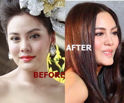 Janie Thianposuwan before and after